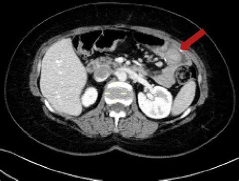 Chronic Gastrojejunal Fistula Plus Intestinal Intussusception As A