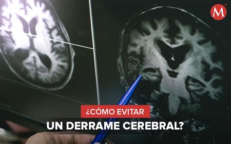 Qué es un infarto cerebral: síntomas y causas - Grupo Milenio