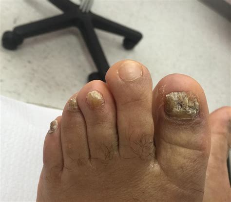 About Toenail Fungus. Before and After Images