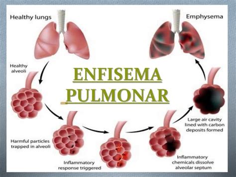 184804175 Enfisema Pulmonarpptx