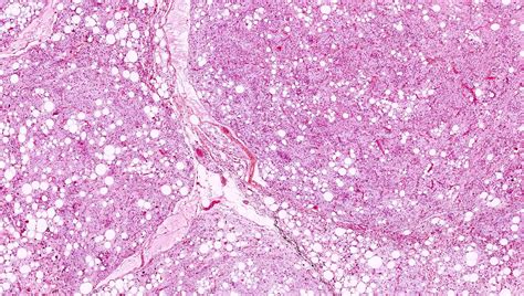 Pathology Outlines Myxoid Pleomorphic Liposarcoma