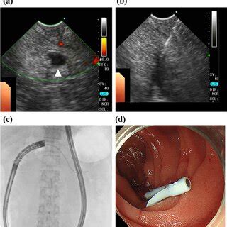 Transjejunal Endoscopic Ultrasoundguided Pancreatic Drainage A