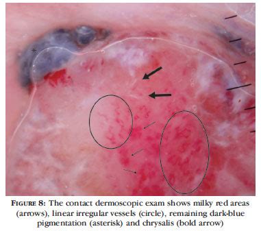 SciELO Brasil Dermoscopic Clues In The Diagnosis Of Amelanotic And