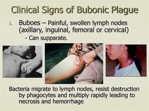 Bubonic Plague Symptoms Buboes