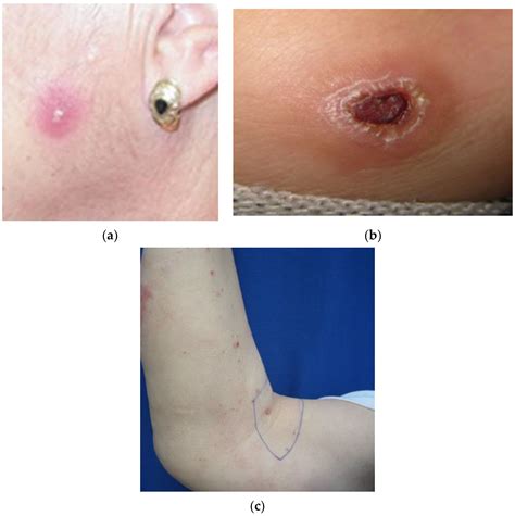 Cutaneous Leishmaniasis