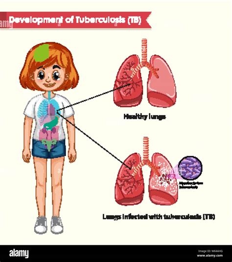 Scientific Medical Illustration Of Tuberculosis Illustration Stock