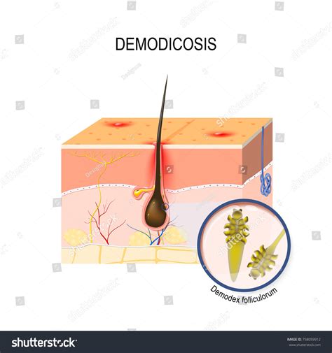 Demodicosis Face Mites Demodex Folliculorum Is Royalty Free Stock Vector 758059912