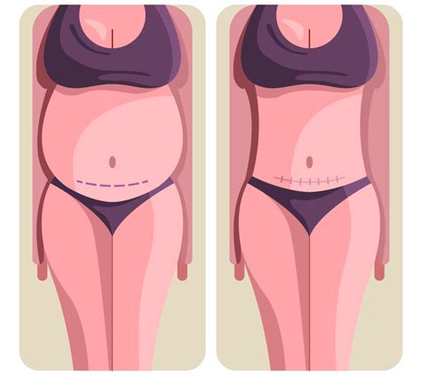 Tummy Tuck Vs Liposuction Which One Is Better For You In 2024