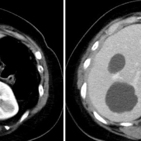 (a) Arterial contrast-enhanced CT demonstrates acute aortic dissection ...