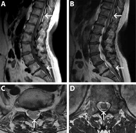 A T1 Weighted Sagittal Magnetic Resonance Imaging Mri Reveals