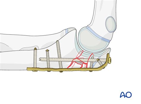 Olecranon Fracture Treatment