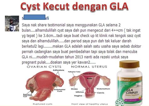 Apa Itu Ovarian Cyst Pengedar Shaklee Pulau Pinang