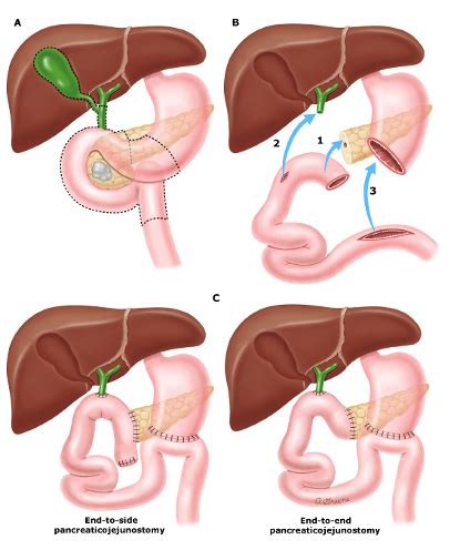 Pancreatic Neoplasia Flashcards Quizlet