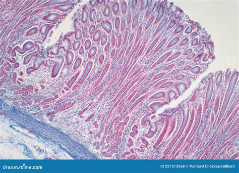 Colon Biopsy From The Colonoscopy Stock Photo Image Of Ache Anus