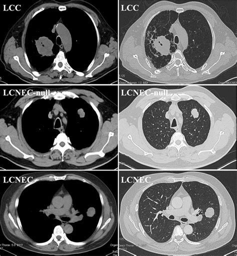 MSCT Multi Slice Computed Tomography Of 3 Typical Cases Of Each