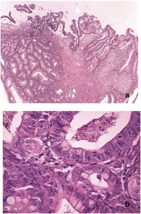 A Cystic Wall Showing A Focal Area With Glandular Proliferation