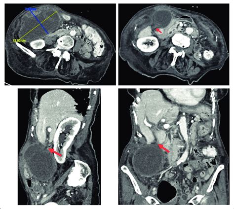 TC de abdomen y pelvis de la paciente que muestra una vesícula biliar