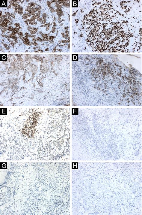 Invasive Clear Cell Variant Of Squamous Cell Carcinoma Mimicking