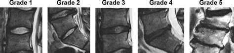 Low Back Pain And Lumbar Degeneration In Japanese Professional Baseball