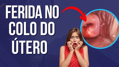 O Que Causa Ferida No Utero - Causas das Feridas no Útero: Entenda os Fatores envolvidos ...