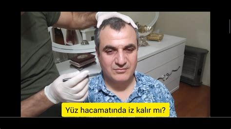 evde yüz hacamatı detaylı anlatım YouTube