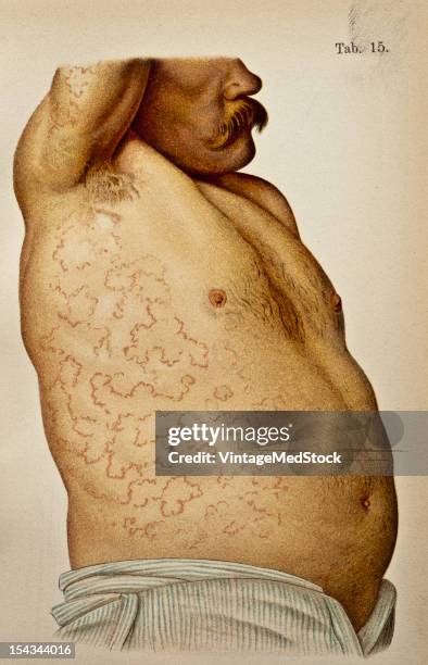 Skin Rash Illustration Photos And Premium High Res Pictures Getty Images