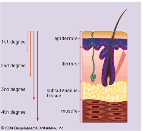 Burns And Wounds Flashcards Quizlet