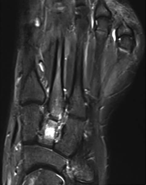 Cuneiform Bone Fracture