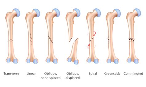 Femur Fracture Treatment