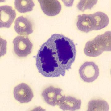 Schizocytes | CellWiki