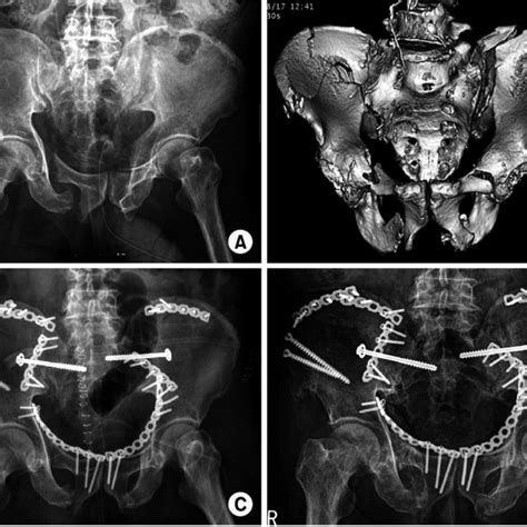 A Year Old Man S A Initial Pelvis Anteroposterior View And B