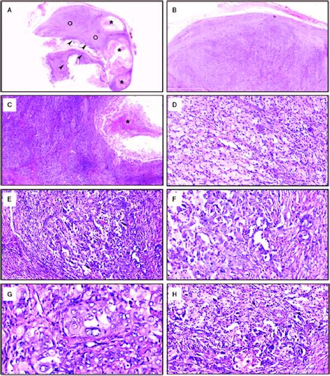 Histologic Features A At Low Magnification The Tumor Is