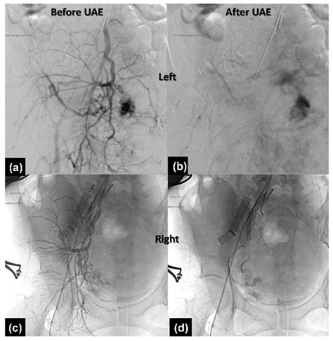 Uterine Artery Embolization For Postpartum Hemorrhage