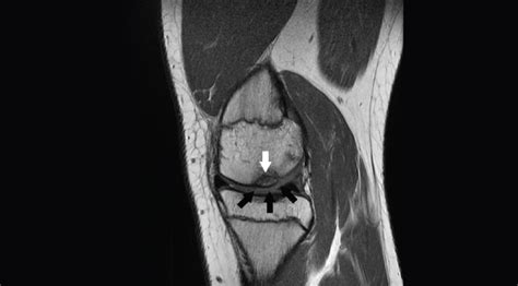 Mri Images Of Problem Knee