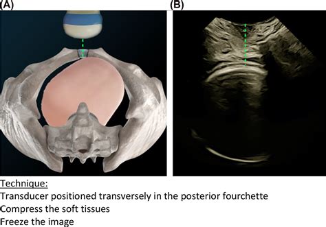 Ultrasound In Labor Clinical Practice Guideline And Recommendation By