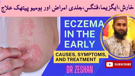 Chambal Ka Ilaj Eczema Ka Ilaj How To Treat Eczema Treatment By Dr