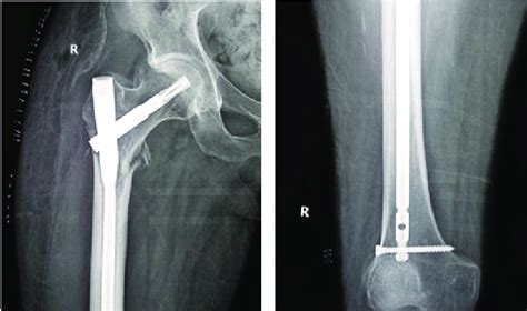 (a and b) The anteroposterior and lateral views of right proximal femur ...