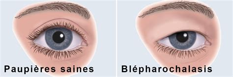 Pathologies palpébrales Annecy Ophtalmo