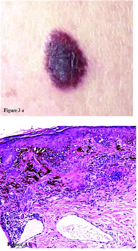 Atypicaldysplastic Nevus On The Trunk With Irregular Borders And Download Scientific Diagram