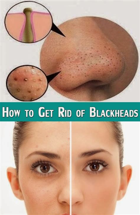 How To Get Rid Of Blackheads Natural Solutions