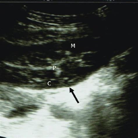 Transverse Ultrasonogram Of The Liver In A 3 Year Old Male Download Scientific Diagram