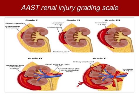 Renal Trauma