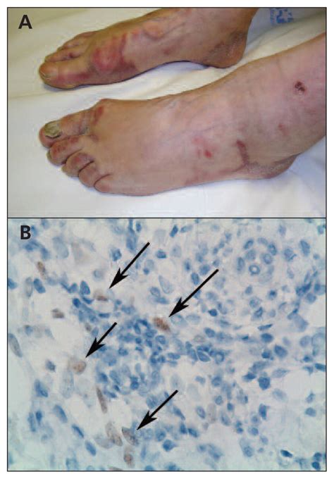 Kaposi Sarcoma Lesions Like