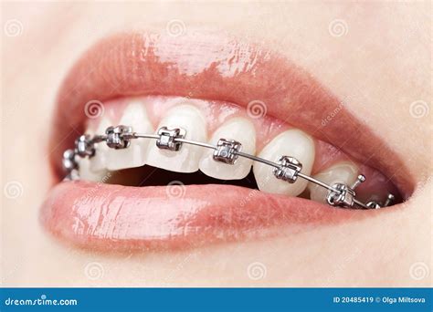 Teeth With Braces Royalty Free Stock Images - Image: 20485419