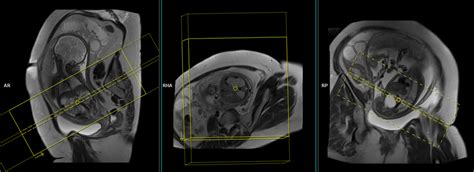 Fetal abdominal MRI | Fetal abdominal MRI protocol and planning