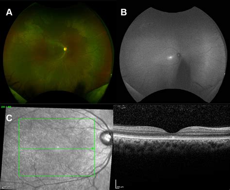 Achromatopsia: for professionals - Gene Vision