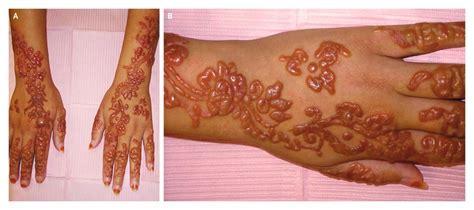 A case of contact eczema due to a 'henna' tattoo