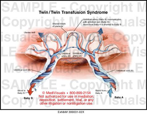 Twin/Twin Transfusion Syndrome Medical Exhibit Medivisuals