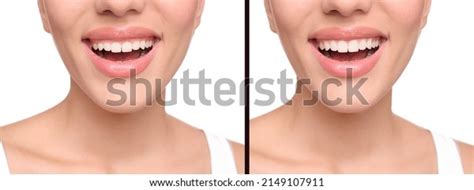 Young Woman Before After Gingivoplasty Procedure Stock Photo 2149107911 ...