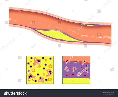 Atheroma Plaque Artery Wall Stock Vector 80984962 - Shutterstock